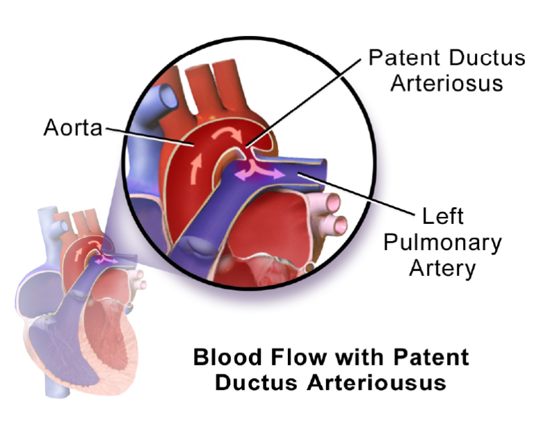 What is Patent Ductus Arteriosus (PDA) Defect? - Dr. Ramji Mehrotra