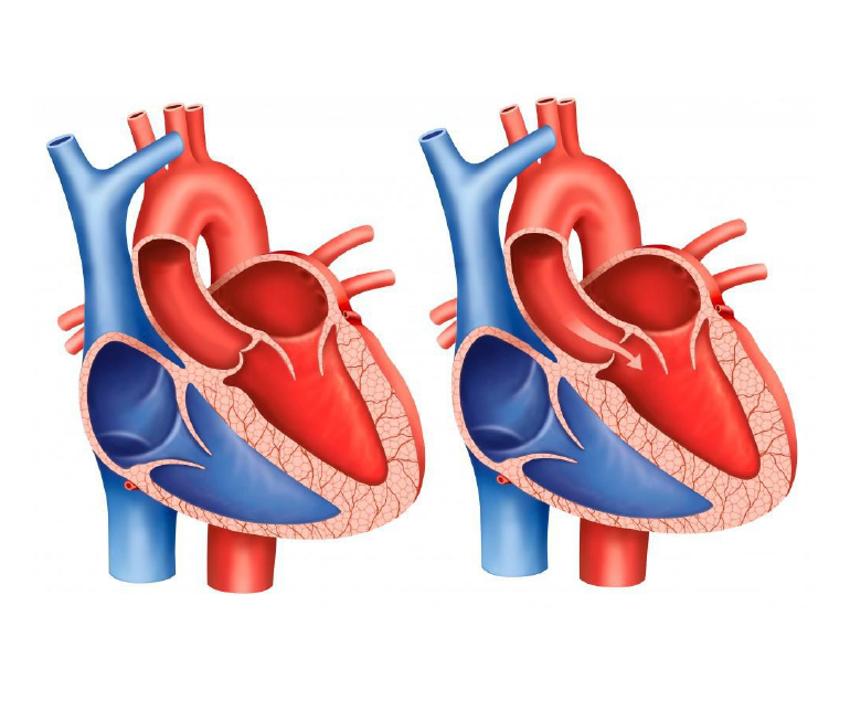 aortic stenosis murmur