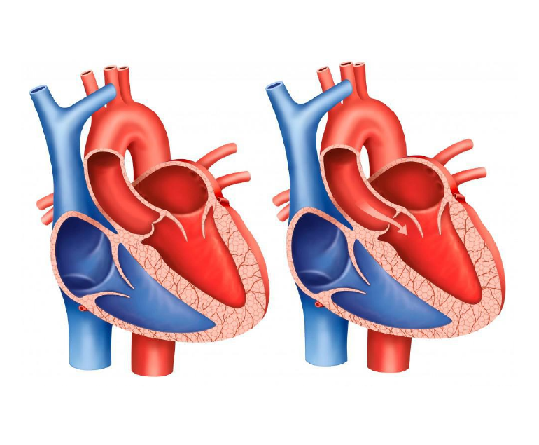 What Is An Aortic Stenosis Murmur Dr Ramji Mehrotra