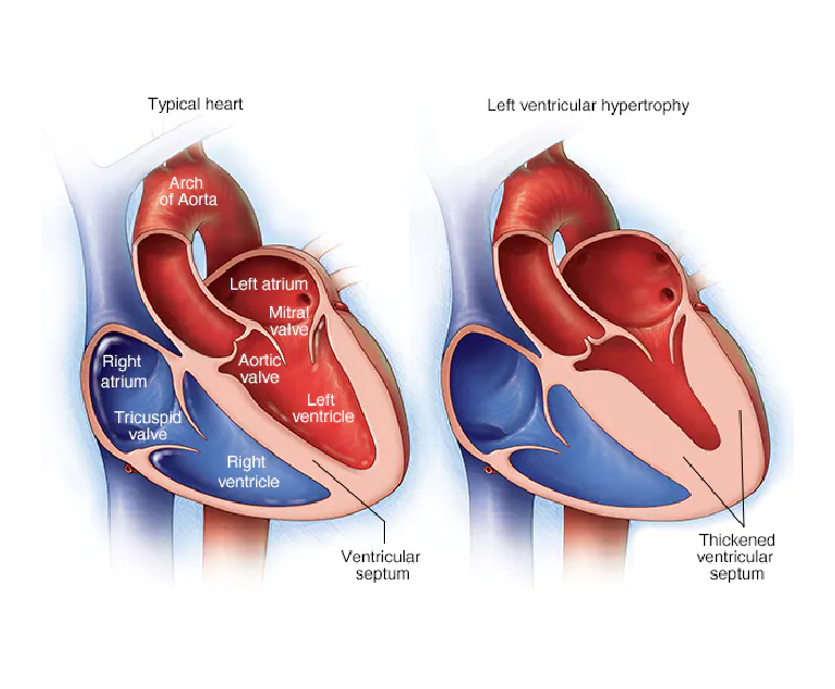Left Ventricle Heart
