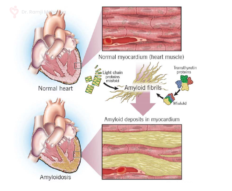 Cardiac Amyloidosis - Dr. Ramji Mehrotra