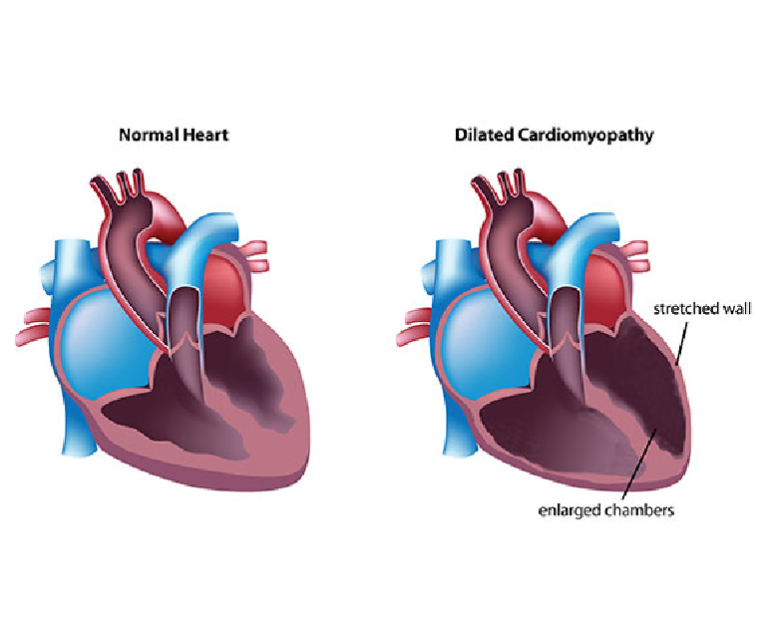 Dilated Cardiomyopathy - Dr. Ramji Mehrotra