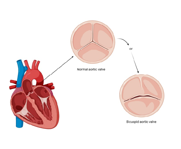 Bicuspid Aortic Valve - Dr. Ramji Mehrotra
